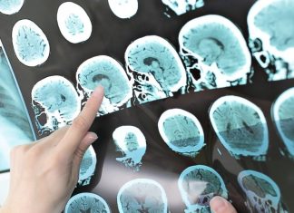 Knowing MS signs can speed diagnosis and treatment – Daily Press