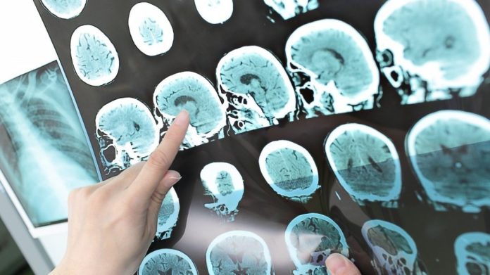 TVP-X-OP-MULTIPLE-SCLEROSIS-VA0130658756.jpg